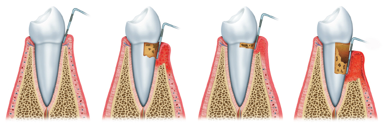 Untreated Gum Disease Causes Irreparable Damage